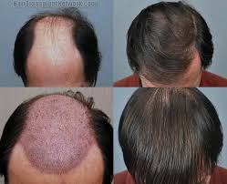 Hair Transplant Singapore - Before And After Image